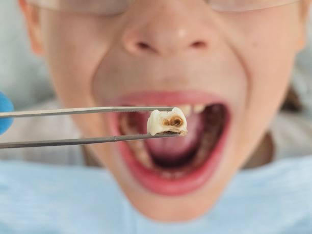 Best Knocked-Out Tooth Emergency  in New Lexington, OH